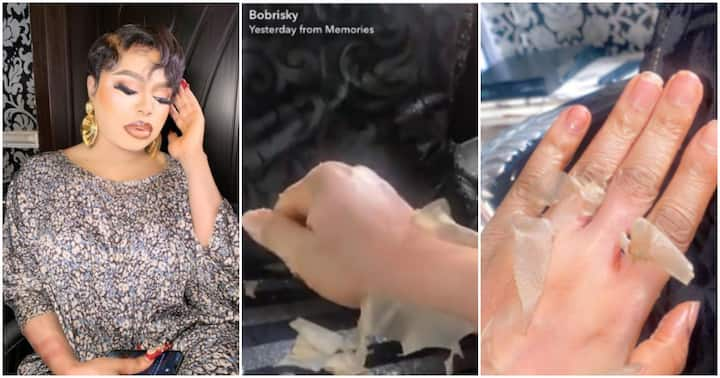 Bobrisky Causes Massive Stir Online After Sharing Photos of His Skin Peeling