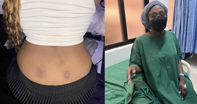 Lady lands in the hospital after getting a back dimple piercing